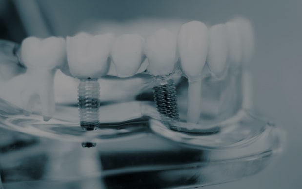 Dental Implants
